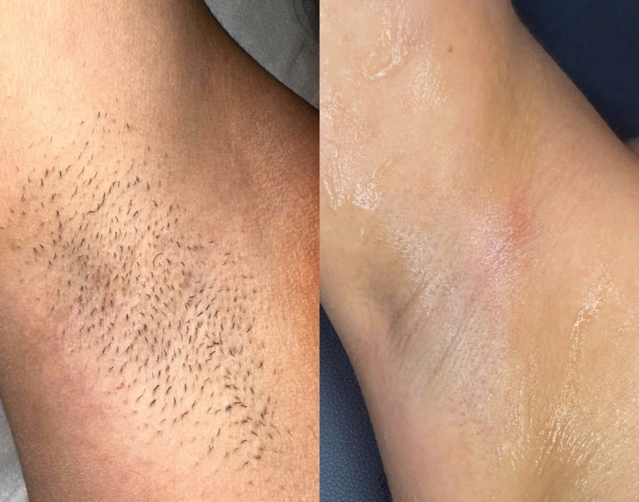 AMAZING INGROWN BUMP SCRUB