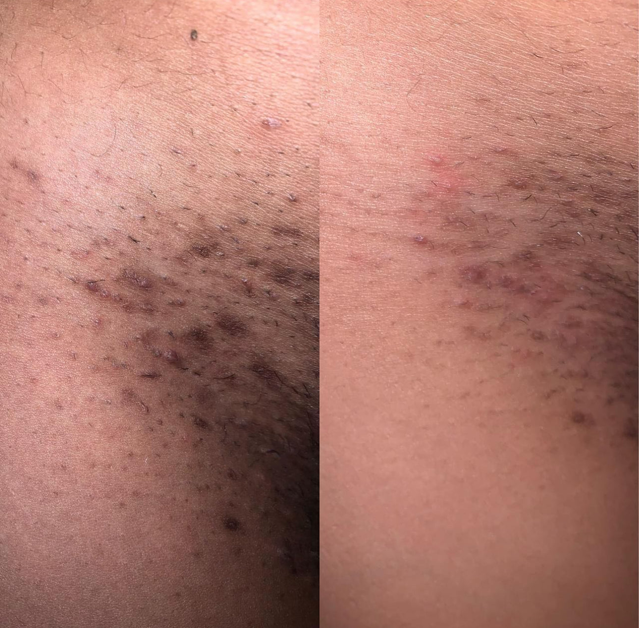 AMAZING INGROWN BUMP SCRUB