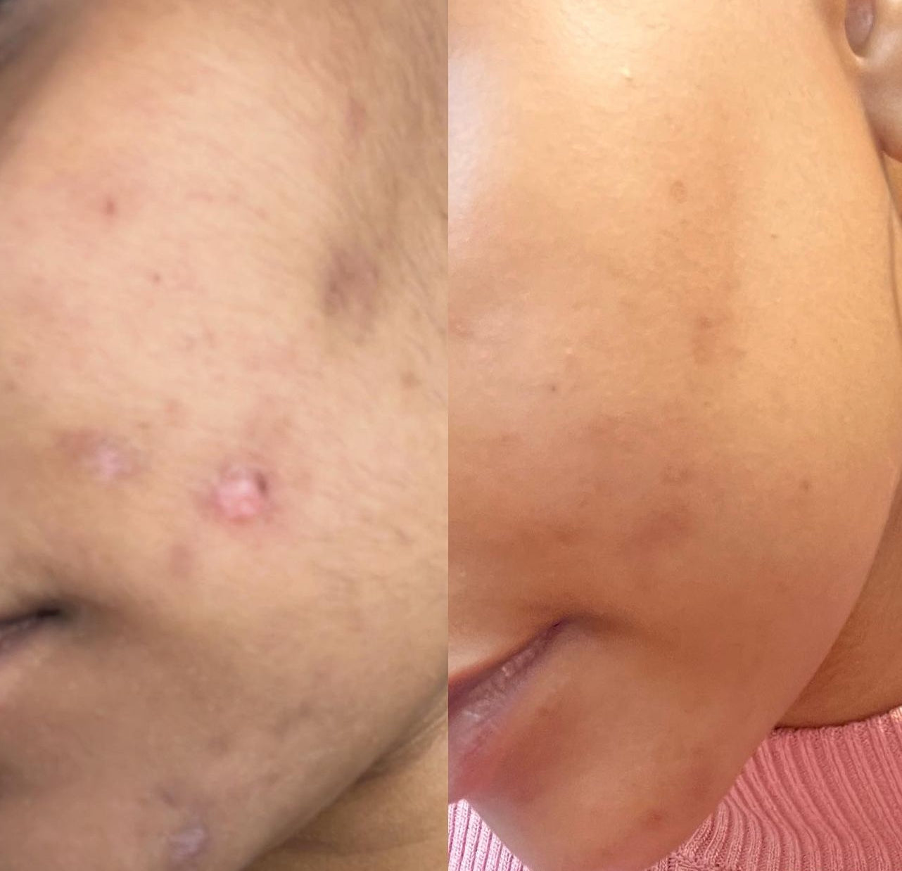 DISCOLORATION PURE KOJIC AND PAPAYA